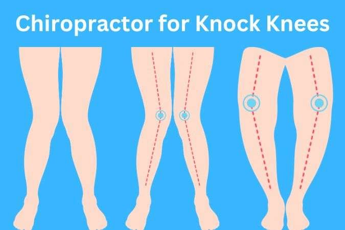 Chiropractor treatment for knock knees