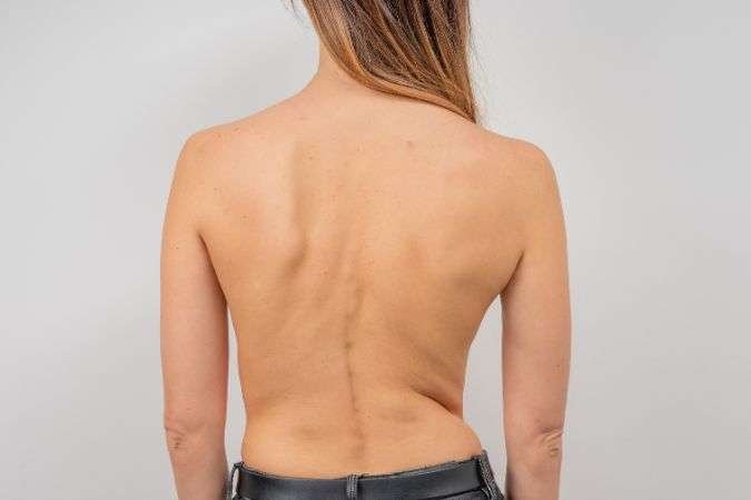 symptoms of scoliosis or curved spine
