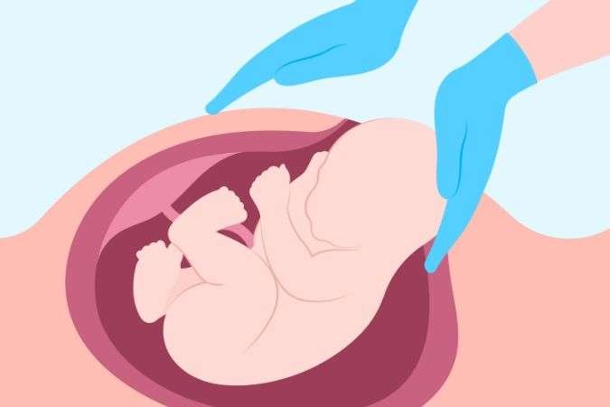 Role of Chiropractor for Breech Baby