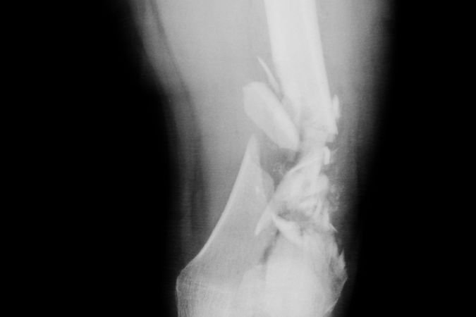 this picture is showing fracture of distal shaft of femur bone. this is how chiropractors diagnose by doing x-ray